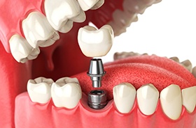 Diagram showing how dental implants in Lebanon are placed