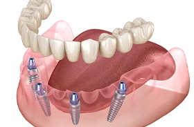 Illustration of All-on-4 dental implants for lower arch