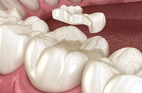 Graphic of dental filling