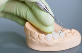 Gloved hand using tool to work on dental bridge
