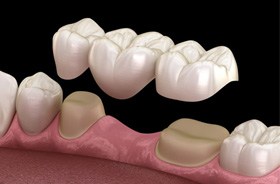 Illustration of three-unit traditional dental bridge