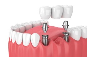 Illustration of dental implant bridge