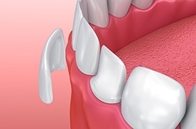 Animation of porcelain veneer placement