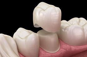 Graphic of dental crown