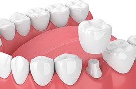 Illustration of dental crown being placed on prepared tooth