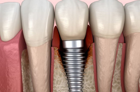 Illustration showing peri-implantitis infection around a dental implant