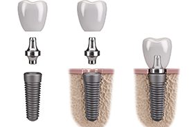 Illustration showing dental implant, abutment, and custom crown