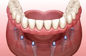 Illustration of full implant dentures for lower arch
