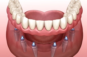 Illustration of full implant dentures for lower arch