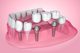 Illustration of three-unit dental implant bridge