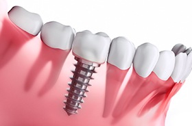 Diagram of how dental implants in Lebanon work