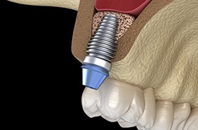 Diagram of sinus lift bone grafting in Lebanon