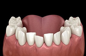 Illustration of crowded, crooked teeth in lower dental arch