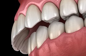 Illustration of an overbite viewed from downward angle