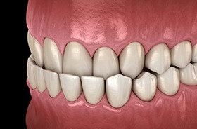 Illustration of an underbite against dark background