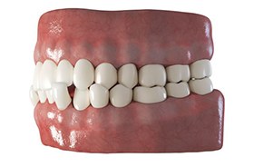 3D illustration of a crossbite against light background