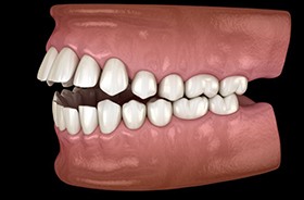 Side-view illustration showing an open bite