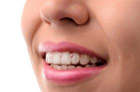 smile wearing Invisalign