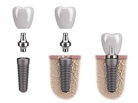 dental implant progression