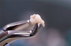 extracted tooth