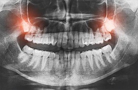 wisdom teeth X-ray