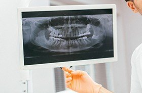 Panoramic dental x-rays