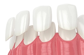 Illustration of veneers being placed on teeth against white background
