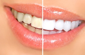Before and after professional teeth whitening in Lebanon
