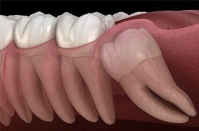 impacted wisdom tooth