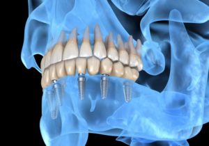 Illustration of six dental implant in Lebanon supporting lower arch