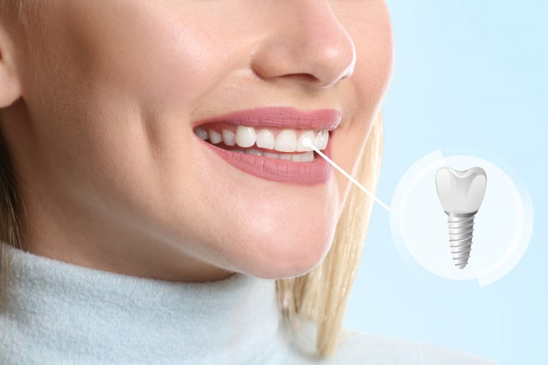 I Just Had A Tooth Extracted When Can I Get A Dental Implant 