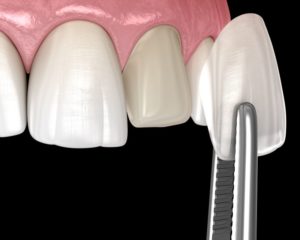 Illustration of veneer being placed on prepared tooth