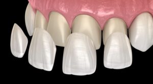 Illustration of four veneers being placed on front teeth