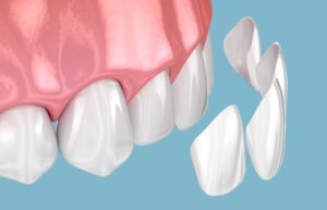 Illustration of veneers being placed on teeth